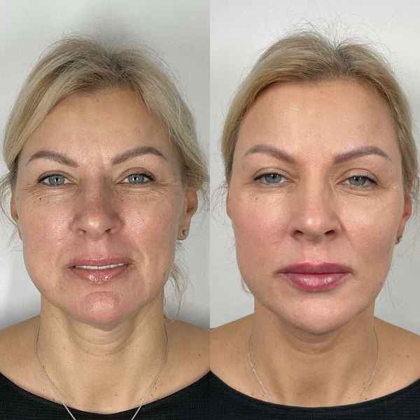 Radiesse dermal fillers at It’s Me and You Clinic in Kingston upon Thames, Surrey and London – liquid facelift procedure to smooth wrinkles and enhance facial contours.