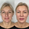 Radiesse dermal fillers at It’s Me and You Clinic in Kingston upon Thames, Surrey and London – liquid facelift procedure to smooth wrinkles and enhance facial contours.