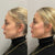 Full face contouring non-surgical liquid facelift before and after results at It’s Me and You Clinic in London, Kingston upon Thames and Surrey – visible facial lift and volume restoration using dermal fillers and Botox.