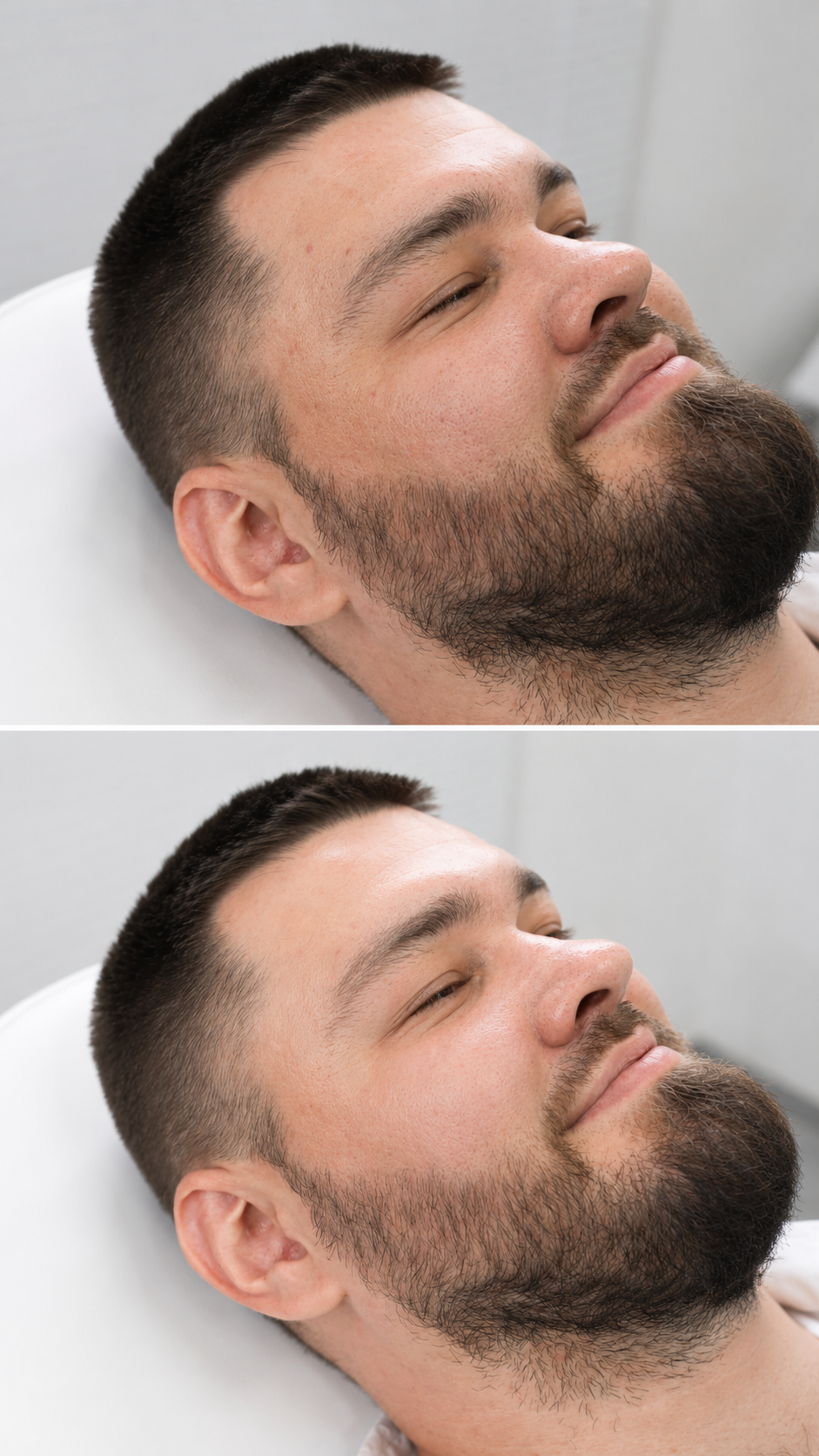 Obagi Blue Peel Radiance before and after at It’s Me & You Skin Clinic in Kingston upon Thames showing clearer, smoother and brighter looking skin after treatment.