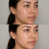 Illustrative Obagi Blue Peel Radiance before and after comparison showing fewer visible blemishes, smoother-looking texture and a clearer, brighter complexion.