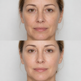 Before and after Profhilo treatment showing improved skin hydration, smoother texture and a fresher, more even-looking complexion.
