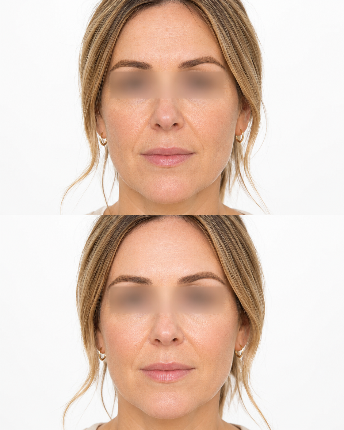 Redensity 1 skin booster before and after image showing a front profile UK woman with improved looking skin hydration and radiance at It’s Me & You Skin Clinic in Kingston upon Thames.