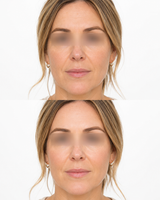 Redensity 1 skin booster before and after image showing a front profile UK woman with improved looking skin hydration and radiance at It’s Me & You Skin Clinic in Kingston upon Thames.