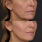 Before and after Sculptra collagen treatment showing improved mid-face support, softened hollowing and smoother, more balanced facial contours in a fourth client.