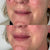 Smokers lines lip and mouth fillers at It’s Me and You Clinic in Kingston upon Thames, Surrey and London – dermal fillers to smooth vertical lip lines and rejuvenate the mouth area.