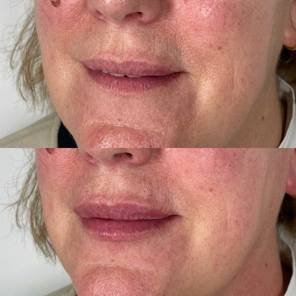 Smokers lines lip and mouth fillers at It’s Me and You Clinic in Kingston upon Thames, Surrey and London – dermal fillers to smooth vertical lip lines and rejuvenate the mouth area.