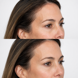 Before and after temple dermal filler showing reduced hollowing and a smoother contour between the forehead, outer brow and upper cheek