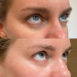 Tinkerbell Nose Tip Lift in Kingston upon Thames, Surrey – Non-Surgical Nasal Enhancement – It's Me & You