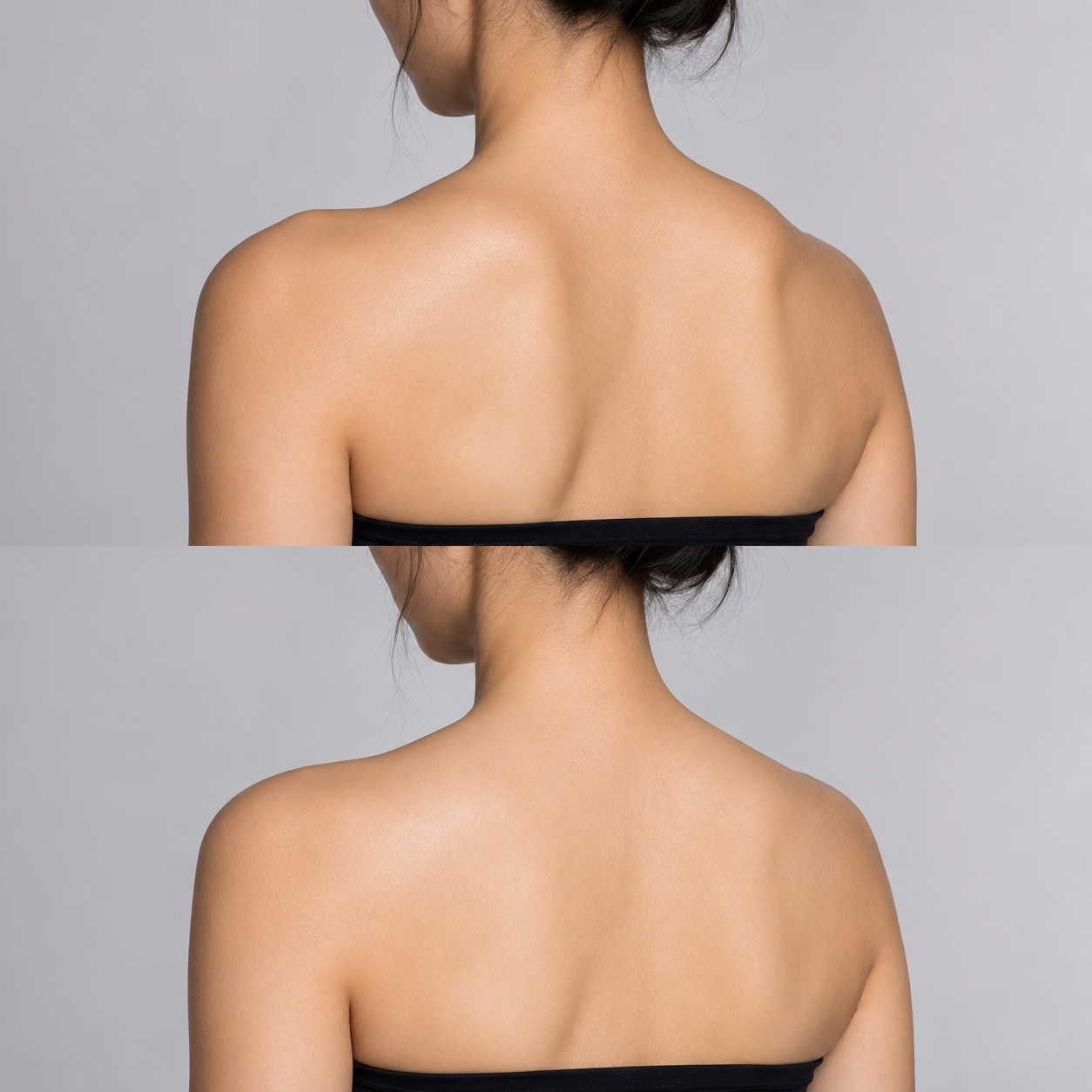 Before and after trapezius contouring showing reduced upper trapezius prominence and a softer, slimmer shoulder line.