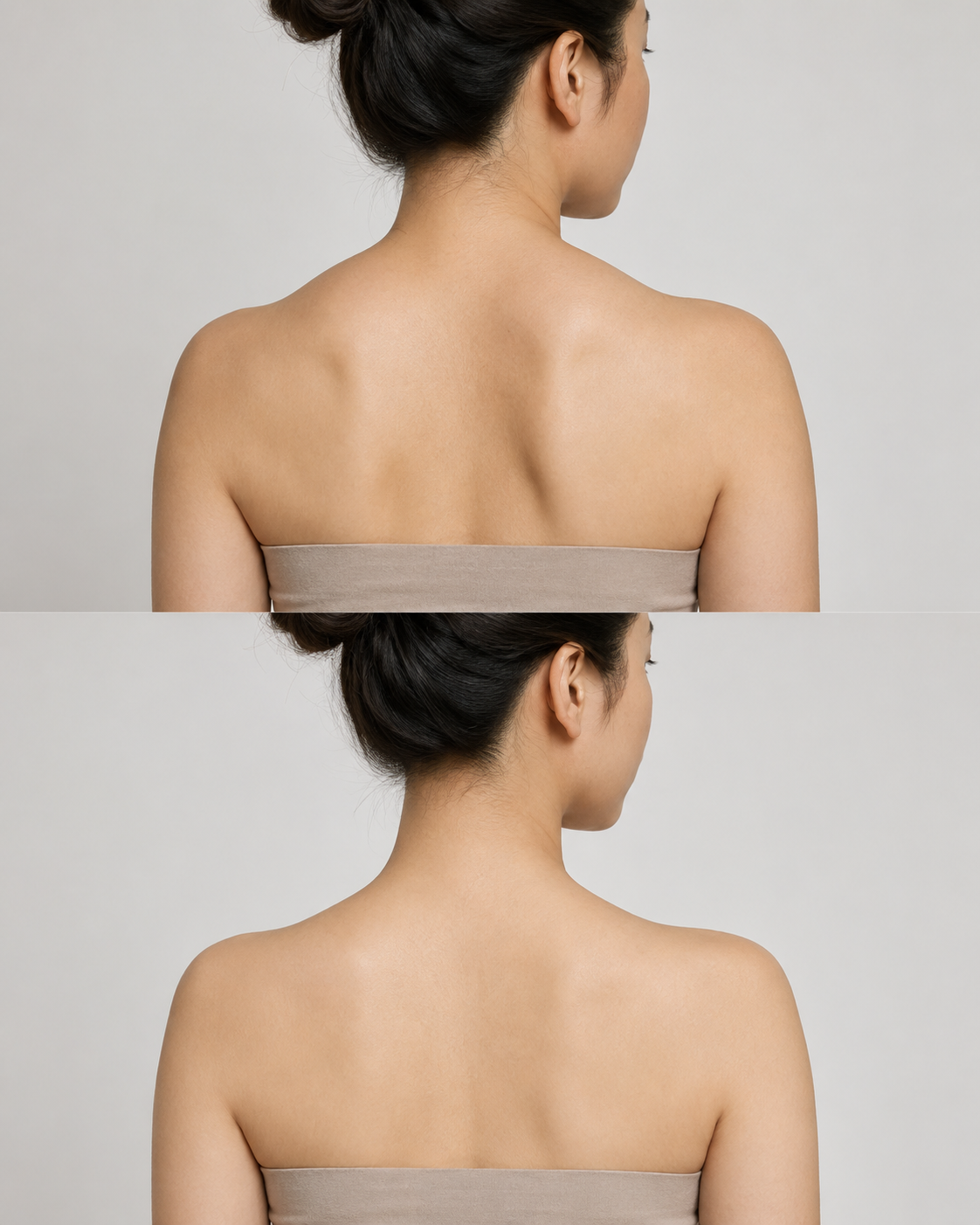 Before and after Traptox image showing a softer neck and shoulder profile after trapezius Botox treatment in Kingston upon Thames near London