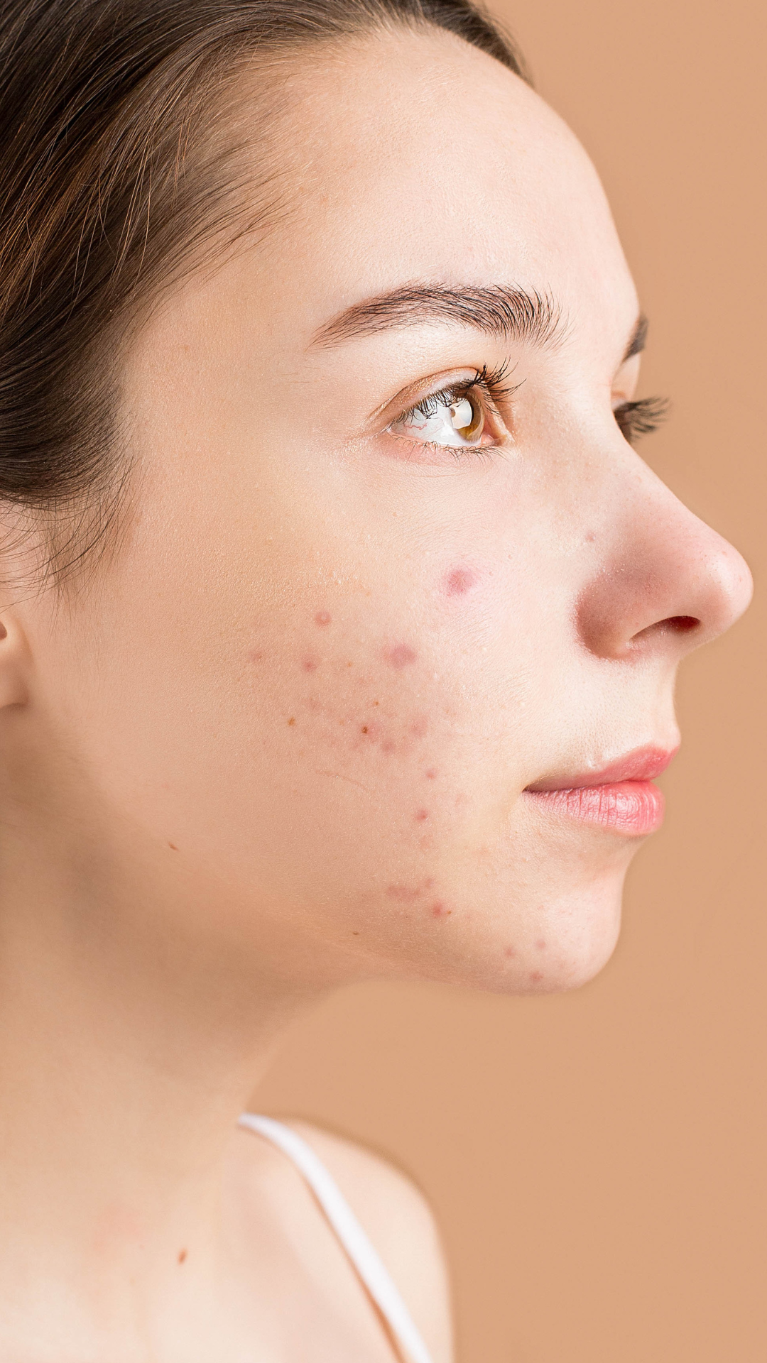 Acne scarring treatment at It’s Me and You Clinic in London, Kingston upon Thames and Surrey – microneedling, chemical peels and laser treatments to reduce acne scars and improve skin texture.