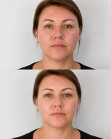Xela Rederm Skin Booster Near East Molesey