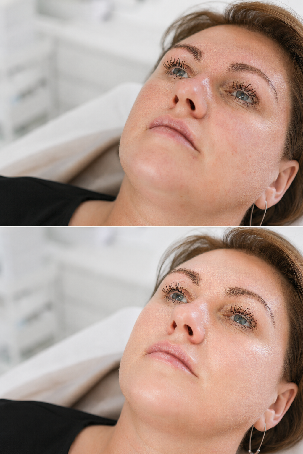 Xela Rederm treatment before and after showing smoother looking, hydrated and refreshed skin at It’s Me & You Skin Clinic in Kingston upon Thames